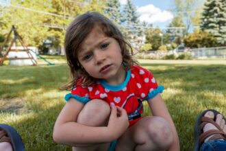 Photo herman syndrome